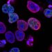 Lo studio dei tag del DNA può portare a una migliore comprensione degli esiti del trattamento del cancro