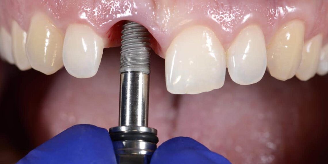 Impianti dentali: la migliore soluzione per riacquisire il sorriso