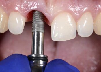 Impianti dentali: la migliore soluzione per riacquisire il sorriso