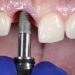 Impianti dentali: la migliore soluzione per riacquisire il sorriso